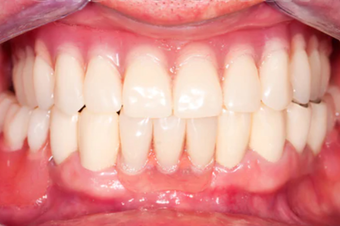 a mouth with a beautiful smile after an affordable denture is placed
