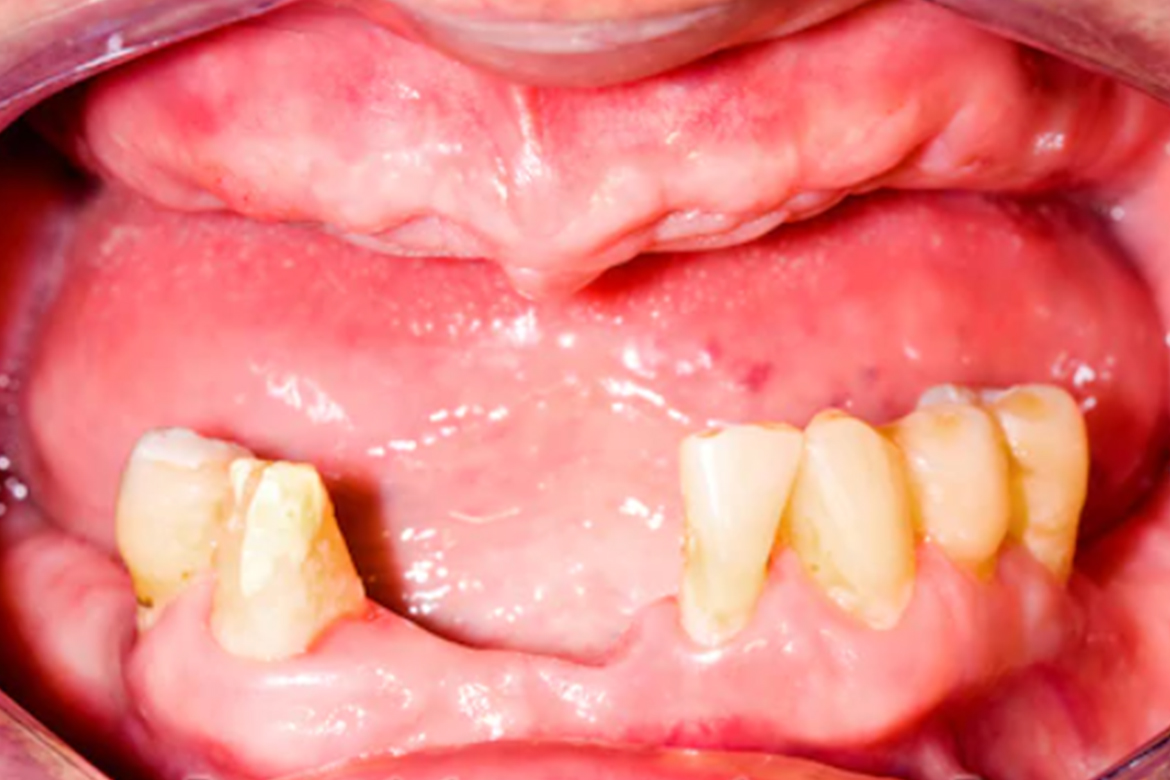 a mouth with missing teeth before a denture is placed that needs decayed teeth extracted