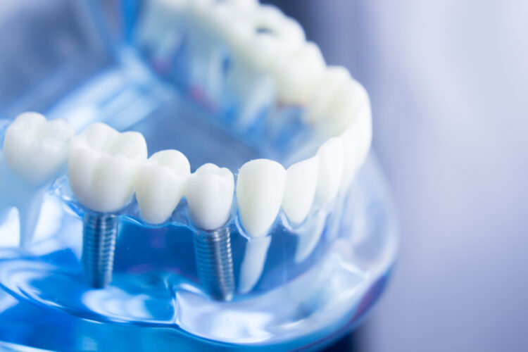 a model of a dental implant